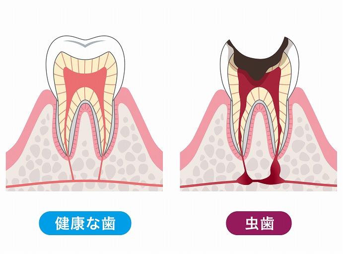 むし歯とは