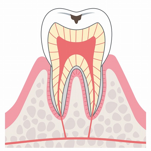 【C1】エナメル質の虫歯