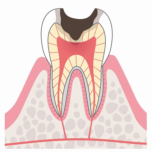 【C2】象牙質の虫歯