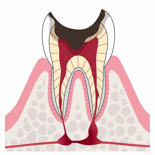 【C3】神経に達した虫歯