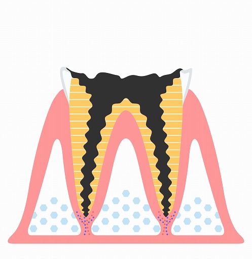【C4】歯根に達した虫歯