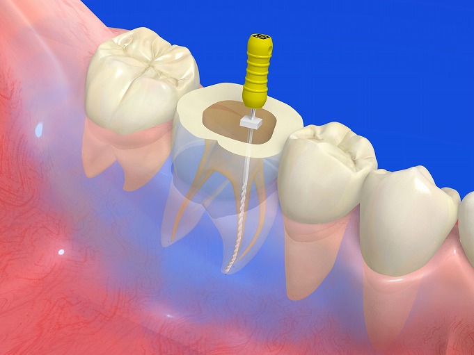 歯の神経の治療(根管治療)とは