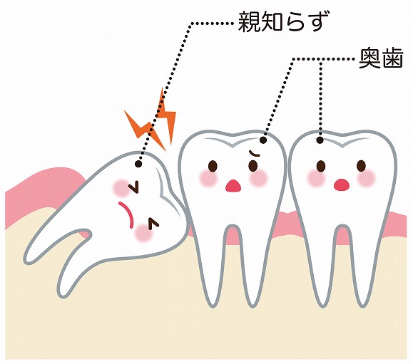 抜いたほうが良い親知らず