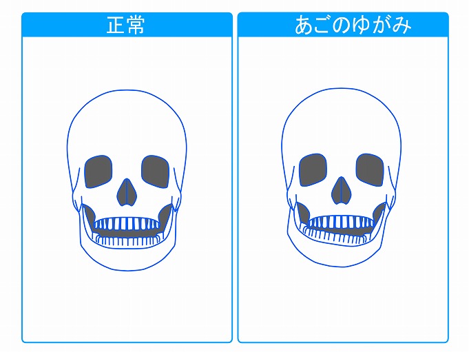 顎関節症とは？