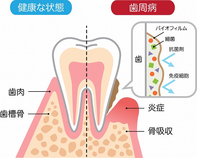歯を失う最大の原因である「歯周病」とは？