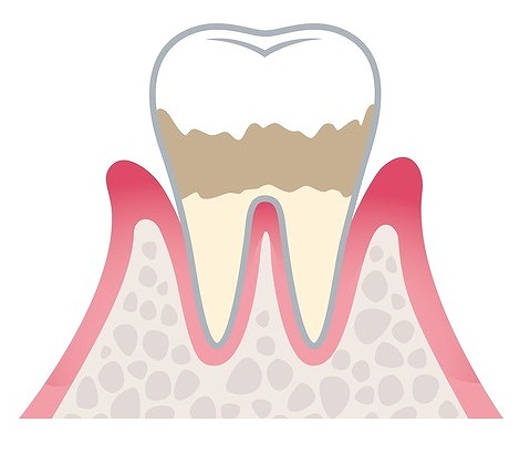 軽度歯周炎