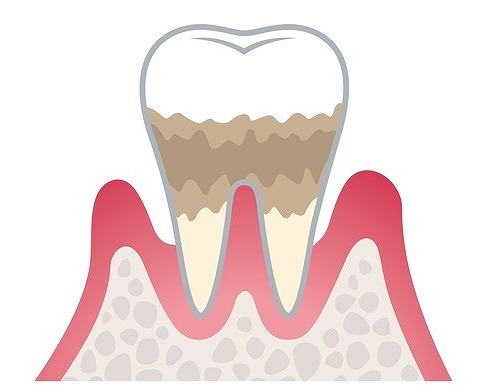 中度歯周炎