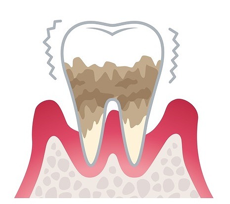 重度の歯周炎