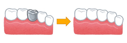 銀歯とセラミックの違い